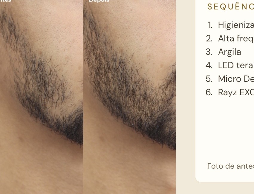 Registro de barba antes e depois do protocolo