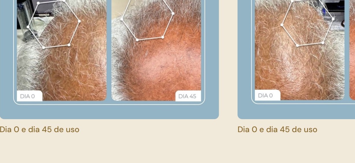 Comparação capilar entre dia 0 e dia 45
